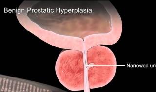 晚上尿多怎么回事